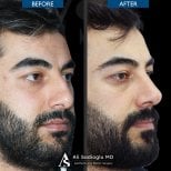 Фото до и после остеотомии при ринопластике, доктор 