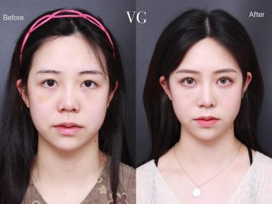 Before and after blepharoplasty results at VG Plastic Surgery, eyelid correction improvement