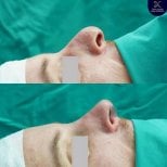 نتائج تجميل الأنف قبل وبعد في Asia Cosmetic Hospital، تحسين شكل الأنف