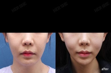 Vorher-nachher-Ergebnis Fadenlifting bei HERSHE Plastic Surgery Korea, verbesserte Gesichtskontur