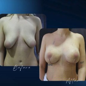 نتائج تصغير الثدي قبل وبعد في عيادة TWT Health Clinic، تحسين شكل الثدي