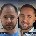 Vorher-nachher-Ergebnis Haartransplantation bei Dr. Safa Manav Clinic, 5 Monate post-op