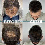 Vorher-nachher-Ergebnis der Haartransplantation in der Dr. Safa Manav Klinik, mehr Dichte