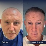 Vorher-nachher-Ergebnis der Haartransplantation in der Dr. Safa Manav Klinik, sichtbare Erholung