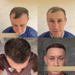 Vorher-nachher-Ergebnis der Haartransplantation bei Dr. Safa Manav Clinic, Haaransatz erneuert
