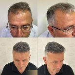 Vorher-nachher-Ergebnis Haartransplantation bei Dr. Safa Manav Clinic, dichteres Haar