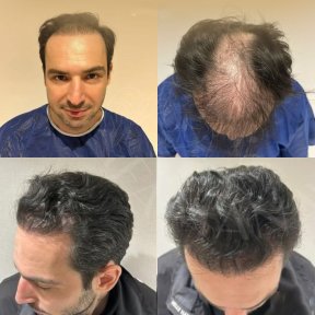 Vorher-nachher-Ergebnis Haartransplantation bei Dr. Safa Manav Clinic, Haarlinie verdichtet