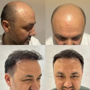 Vorher-nachher-Ergebnis Haartransplantation bei Dr. Safa Manav Clinic, volle Haarlinie