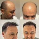 Vorher-nachher-Ergebnis Haartransplantation bei Dr. Safa Manav Clinic, volle Haarlinie