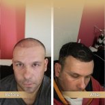 Vorher-nachher-Ergebnis Haartransplantation bei Dr. Safa Manav Clinic, Haaransatz wiederhergestellt