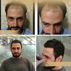 Vorher-nachher-Ergebnis Haartransplantation bei Dr. Safa Manav Clinic, wiederhergestellte Haarlinie