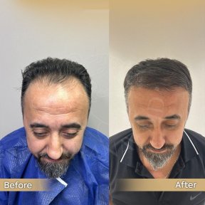 Vorher-nachher-Ergebnis Haartransplantation bei Dr. Safa Manav Clinic, Haaransatz wiederhergestellt