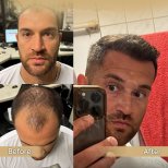 Vorher-nachher-Ergebnis Haartransplantation bei Dr. Safa Manav Clinic, volle Haarlinie