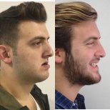 Before and after sliding genioplasty results at Dentavie Istanbul Dental Clinic, chin contouring