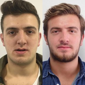 Before and after sliding genioplasty result at Dentavie Istanbul Dental Clinic, chin reshaping