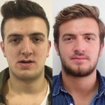 Before and after sliding genioplasty result at Dentavie Istanbul Dental Clinic, chin reshaping