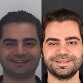 Before and after sliding genioplasty results at Dentavie Istanbul Dental Clinic, chin contouring