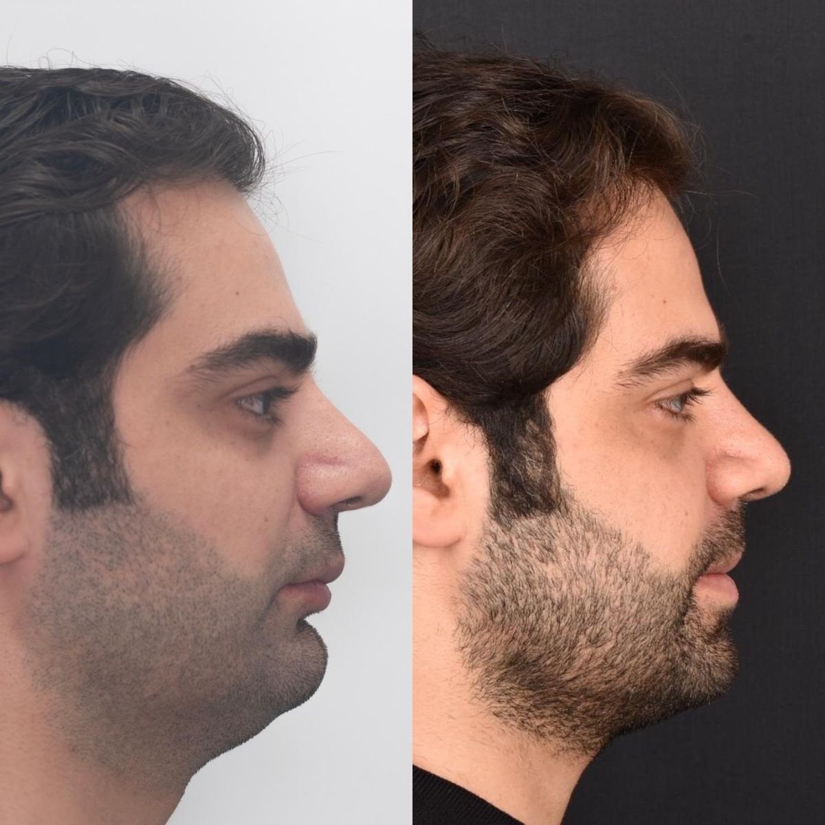 قبل وبعد جراحة تجميل الذقن في Dentavie Istanbul Dental Clinic، تحسين شكل الذقن