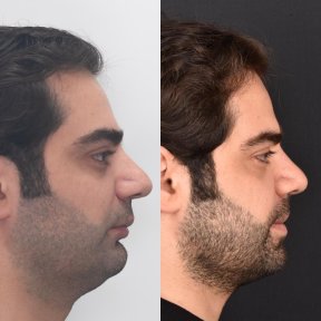 Before and after sliding genioplasty at Dentavie Istanbul Dental Clinic, chin profile improvement result