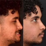 Before and after sliding genioplasty result at Dentavie Istanbul Dental Clinic, chin reshaping