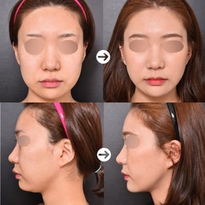 Before and after threads lifting results at VG Plastic Surgery, facial contour improvement