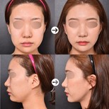 Before and after threads lifting results at VG Plastic Surgery, facial contour improvement