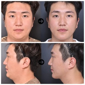 Before and after threads lifting results at VG Plastic Surgery, visible facial contour improvement