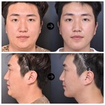 Before and after threads lifting results at VG Plastic Surgery, visible facial contour improvement