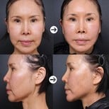 Before and after threads lifting results at VG Plastic Surgery, facial contour improvement