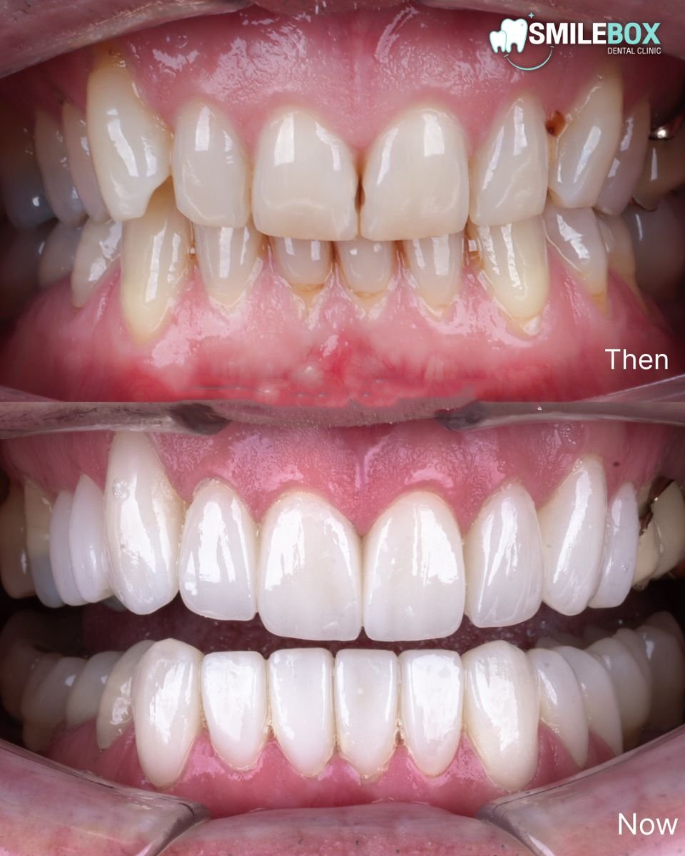 Resultado antes y después de carillas en SmileBox Dental Clinic - Thonglor, Sukhumvit Branch