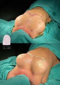 نتائج تكبير الثدي قبل وبعد في Dr. MED، تحسين شكل وحجم الثدي