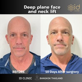 Before and after deep plane face and neck lift results at ID Clinic Bangkok, visible rejuvenation