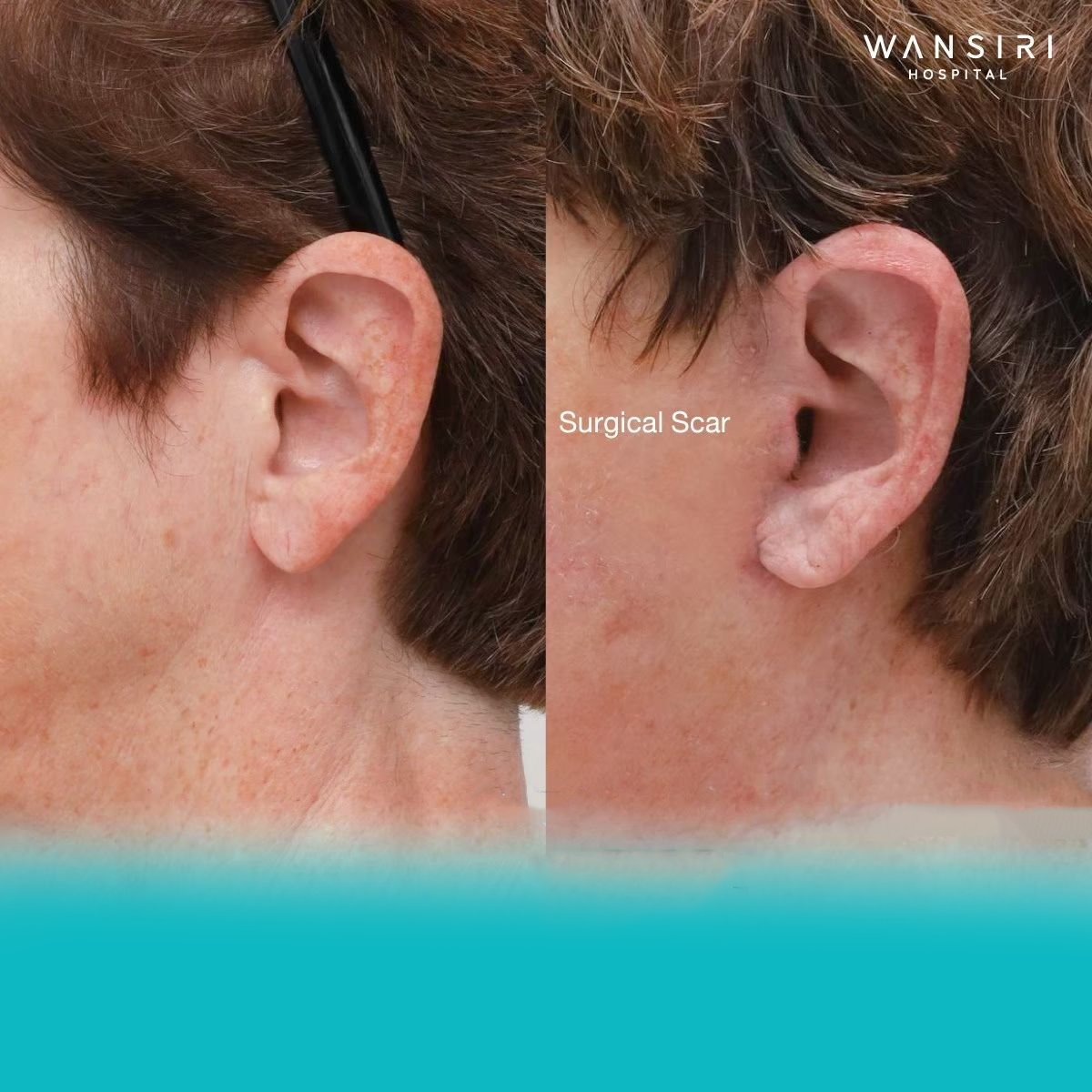 Resultados antes y después de lifting facial deep plane en Wansiri Hospital, cicatriz visible