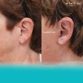 Результати до і після deep plane підтяжки обличчя у Wansiri Hospital, видно шрам біля вуха