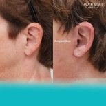 Результати до і після deep plane підтяжки обличчя у Wansiri Hospital, видно шрам біля вуха