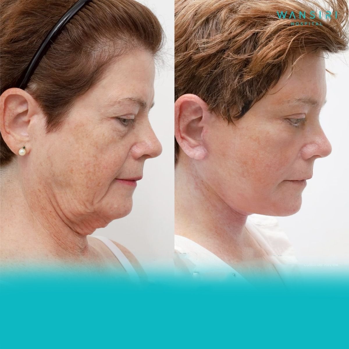 Resultados antes y después de deep plane facelift en Wansiri Hospital, rejuvenecimiento facial
