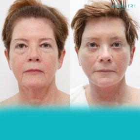 Результати до і після deep plane facelift у Wansiri Hospital, помітне омолодження обличчя