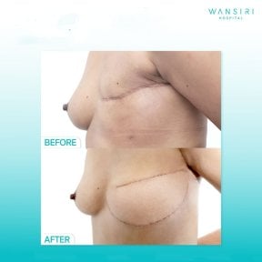 نتائج قبل وبعد تكبير الثدي في مستشفى وانسيري، تحسين شكل الثدي