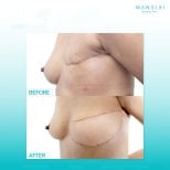 نتائج قبل وبعد تكبير الثدي في مستشفى وانسيري، تحسين شكل الثدي