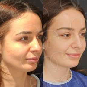 Facelift before and after results at Dr. Safa Manav Clinic, visible facial rejuvenation