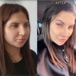 Facelift before and after results at Dr. Safa Manav Clinic, visible facial rejuvenation