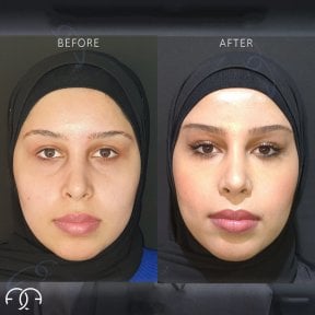 Facelift before and after results at Dr. Safa Manav Clinic, facial rejuvenation and contouring