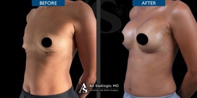 Before and after breast lift with implants round result at Dr. Safa Manav Clinic