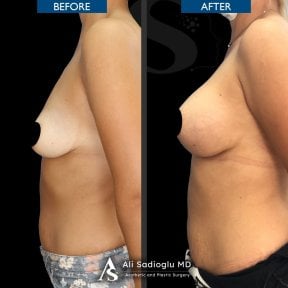 Before and after breast lift with implants results at Dr. Safa Manav Clinic, round shape