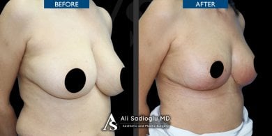 Before and after breast lift with round implants results at Dr. Safa Manav Clinic