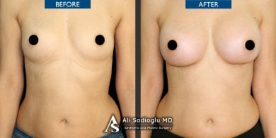 Before and after breast lift with round implants results at Dr. Safa Manav Clinic