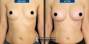Before and after breast lift with round implants results at Dr. Safa Manav Clinic