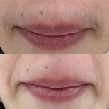 Before and after laser hair removal results on upper lip at Wansiri Hospital