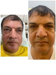 Resultados antes y después de terapia de rejuvenecimiento con células madre en ID Clinic Bangkok