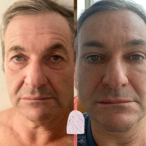 Facelift before and after results at Dr. MED – visible facial rejuvenation and tighter skin
